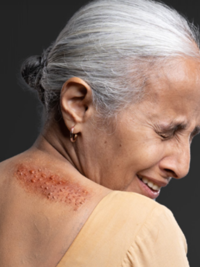 Herpes Shingles : जानिए इस दर्दनाक संक्रमण के बारे में सबकुछ